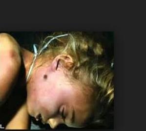 JonBenet Ramsey Autopsy Photo