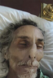 A man in a hospital bed with a mask on his face.